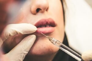 Preenchimento labial